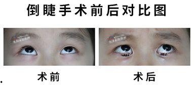 倒睫手术视频,专业视角下的手术技巧与恢复