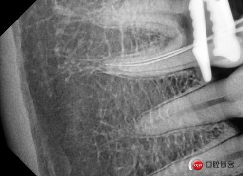 屁股脓包引流手术视频,屁股脓包引流手术全过程揭秘