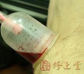 放痧疗法视频,放痧疗法视频揭秘